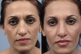 Laser Fractional Co2 Clinic in Islamabad