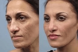 Laser Fractional Co2 in Islamabad Pakistan