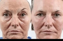 Laser Fractional Co2 in Islamabad