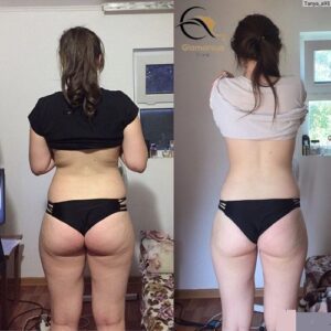 Fat Melting Injections Before & After