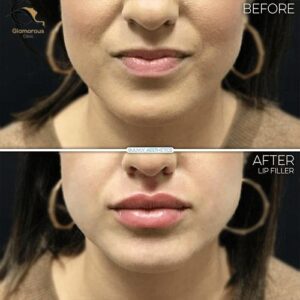 botox lip flip before & after 