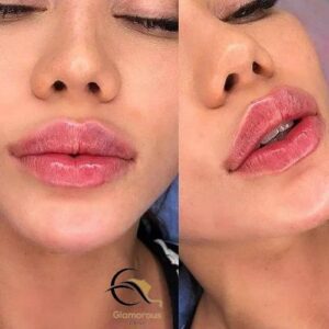 botox lip flip before & after 