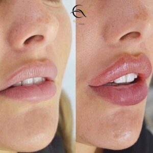 botox lip flip before & after 