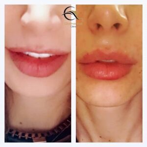 botox lip flip before & after 