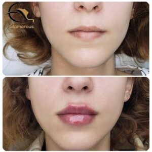 botox lip flip before & after 