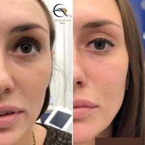 Botox For Sweating Glands Before & After