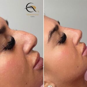 nose fillers injections before & After 