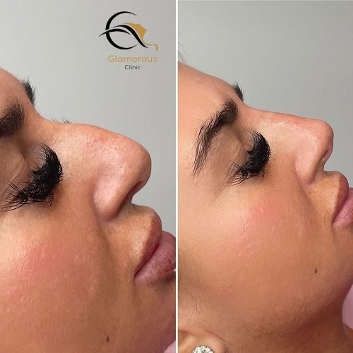 nose fillers injections before & After