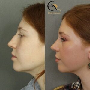nose fillers injections before & After 