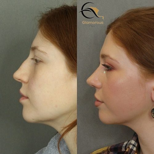 nose fillers injections before & After