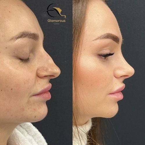nose fillers injections before & After
