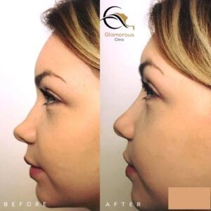 nose fillers injections before & After 