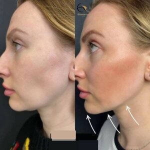 Double Chin Removal before & After