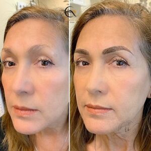 Brow lift Surgery before & after