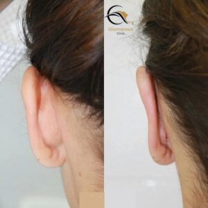 ear reshaping otoplasty before & After 