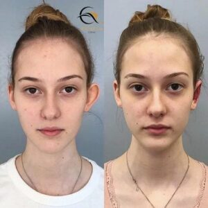 ear reshaping otoplasty before & After 
