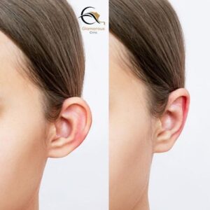 ear reshaping otoplasty before & After 