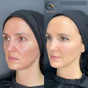 vampire facelift before & after