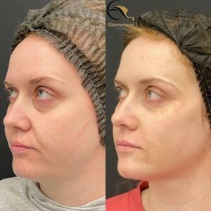 vampire facelift before & after