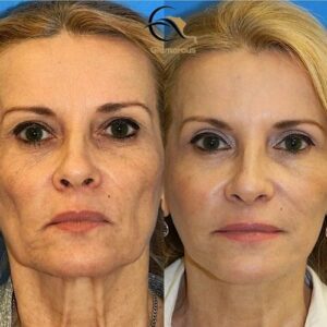 vampire facelift before & after