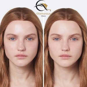 Forehead Lift before & after