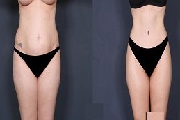 Liposuction Cost Before & After clinic in Islamabad