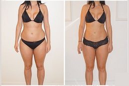 Liposuction Cost Before & After in Islamabad
