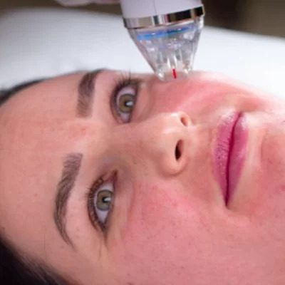 Can Microneedling Help With Fine Lines & Wrinkles?