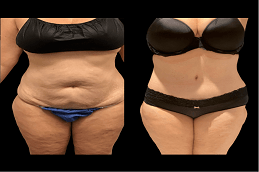 Results OF Liposuction Cost Islamabad