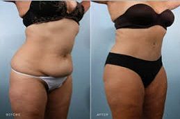 Results OF Liposuction Cost clinic Islamabad