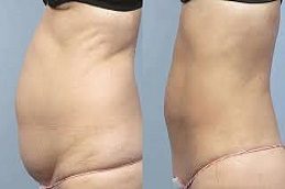Results OF Liposuction Cost clinic in Islamabad