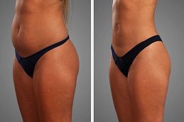 Results OF Liposuction Cost in Islamabad