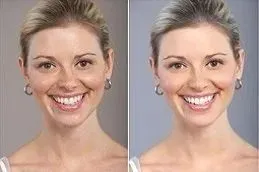 glutathione injections in islamabad Glutathione Injection in Islamabad, Pakistan