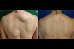 Lipoma treatment before & After