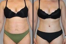 Liposuction before & after