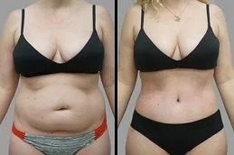 Liposuction before & After