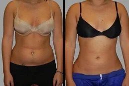 Liposuction in islamabad