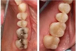 Root Canal Treatment before & After in islamabad