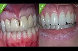 Root Canal Treatment before & After