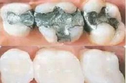 Root Canal Treatment clinic islamabad