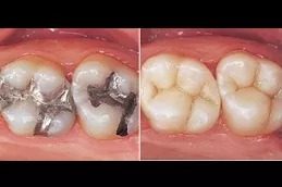 Root Canal Treatment clinic