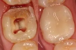 Root Canal Treatment in islamabad