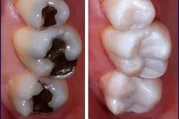 Root Canal Treatment