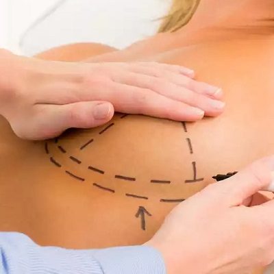 What is the Cost of Breast Surgery?
