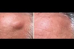 lipoma-treatment best clinic in Islamabad