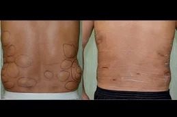 lipoma-treatment clinic in Islamabad