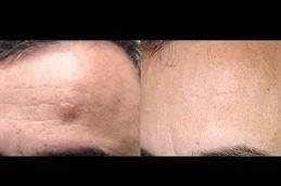lipoma-treatment clinic in Islamabad