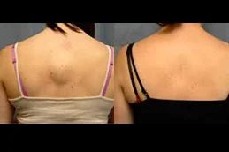 lipoma-treatment in Rawalpindi