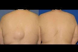 lipoma-treatment islamabad