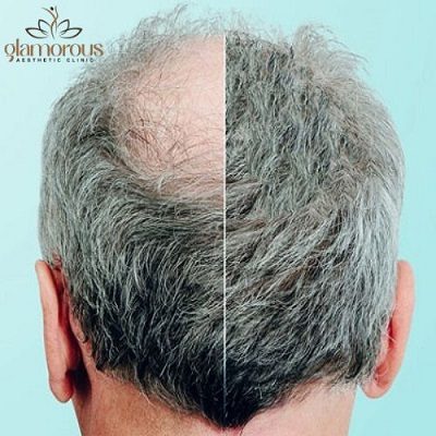 Best Age For A Hair Transplant In Islamabad?